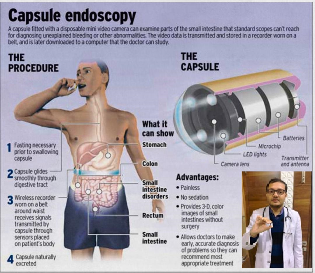 Capsule endoscopy procedure infographic